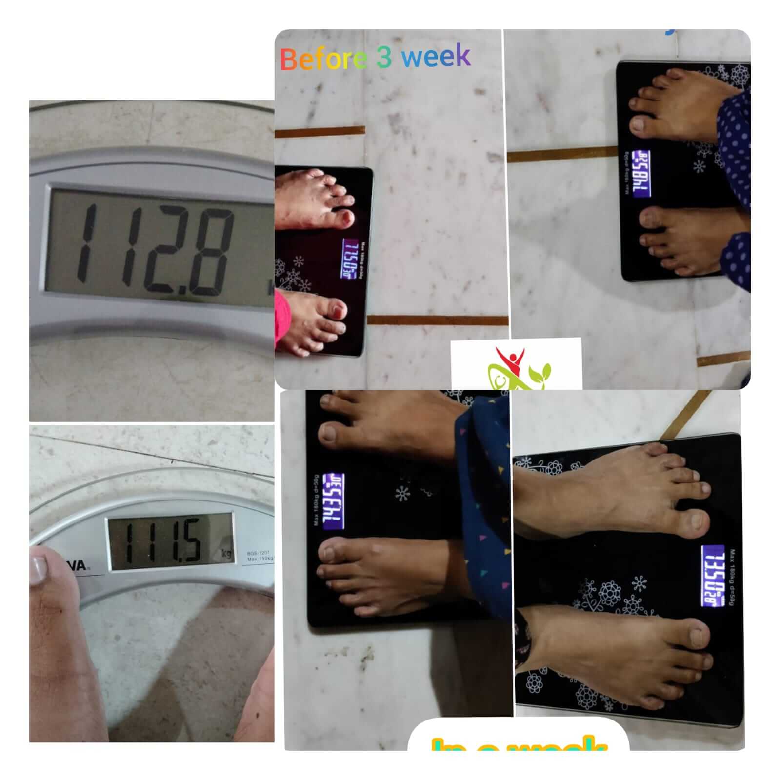Hypothyroidism Diet Plan Bopal Ahmedabad